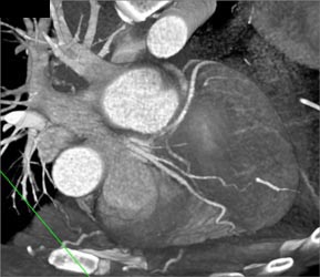 LAD and Circumflex Artery (CX) Directly Off Left Cusp - CTisus CT Scan