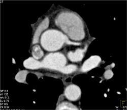 Normal LAD - CTisus CT Scan