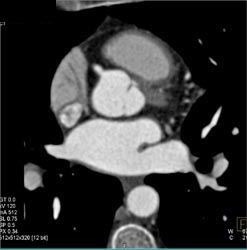 Normal RCA - CTisus CT Scan