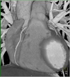 Normal RCA - CTisus CT Scan