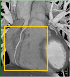 Step Off Due to Incorrect Phase of Reconstruction-see Sequence of Images - CTisus CT Scan