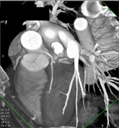 Normal LAD - CTisus CT Scan