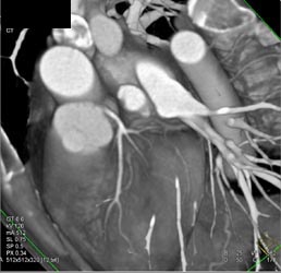 Normal LAD - CTisus CT Scan