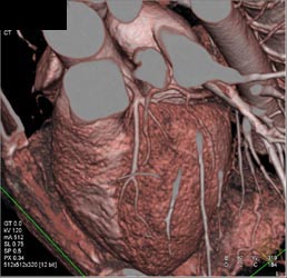 Normal LAD - CTisus CT Scan