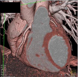 Normal RCA - CTisus CT Scan