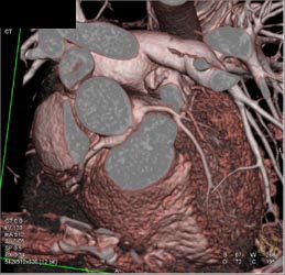 Normal LAD - CTisus CT Scan