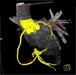 Normal LAD - CTisus CT Scan