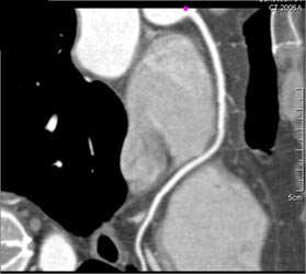 Normal LAD - CTisus CT Scan