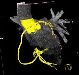 Normal LAD - CTisus CT Scan