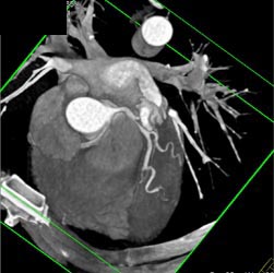 Normal LAD and Circumflex But RCA Off Left Cusp-see Sequence - CTisus CT Scan