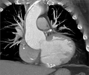 LAD Disease - CTisus CT Scan