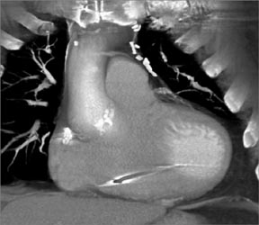 Left Internal Mammary Artery (LIMA) Bypass Graft and Clips - CTisus CT Scan