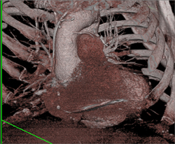 Coronary CT Angiography of A Patent Bypass Graft - CTisus CT Scan