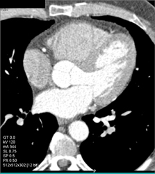 Patent and Normal RCA - CTisus CT Scan