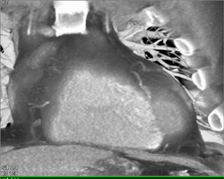 Normal LAD - CTisus CT Scan