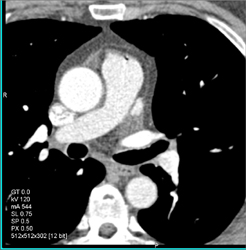 Normal LAD - CTisus CT Scan