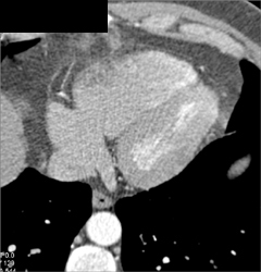 Normal RCA - CTisus CT Scan