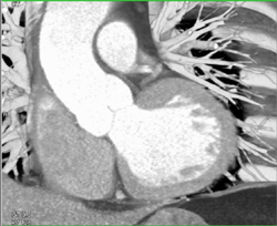 Normal RCA - CTisus CT Scan