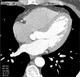 Normal RCA - CTisus CT Scan