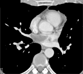 Metastatic Sarcoma to the Pulmonary Veins and Left Atrium - CTisus CT Scan