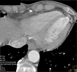 Left Ventricle Aneurysm - CTisus CT Scan