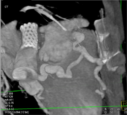 SVC Stent With Dilated Coronary Veins - CTisus CT Scan