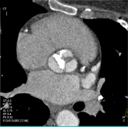 Calcified Aortic Valve - CTisus CT Scan