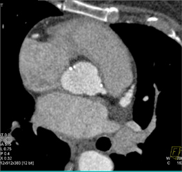 Extensive Calcified Plaques in LAD and Circumflex Coronary Arteries - CTisus CT Scan