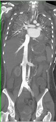 IVC and Renal Veins as Well as Hepatic Veins Are Defined - CTisus CT Scan