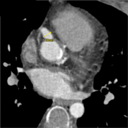 Right Coronary Artery Aneurysm - CTisus CT Scan