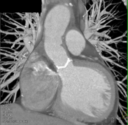 Aortic Valve Replacement - CTisus CT Scan