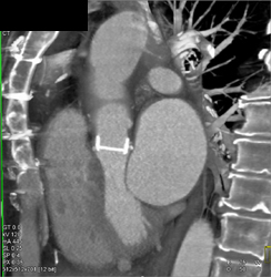 Aortic Valve Replacement - CTisus CT Scan