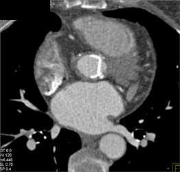 Aortic Valve Replacement - CTisus CT Scan