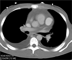 Aneurysm of the LAD With Hemopericardium - CTisus CT Scan