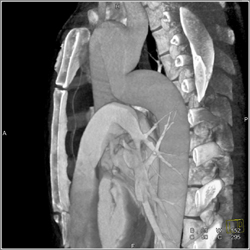 Pseudo-Coarctation - CTisus CT Scan