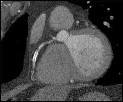 Stent in RCA With Stenosis Pre-stent - CTisus CT Scan