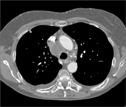 SVC Thrombus With Collaterals. Tumor Invades the SVC - CTisus CT Scan