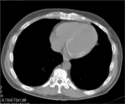 Dense Myocardium Die to Renal Failure - CTisus CT Scan