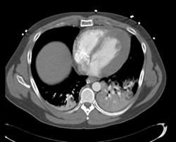 LV Infarction - CTisus CT Scan