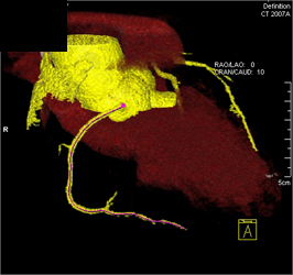 Normal RCA - CTisus CT Scan