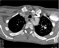 Stent in Right Pulmonary Artery Which Is Patent - CTisus CT Scan