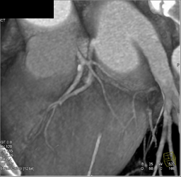 Plaque in LAD - CTisus CT Scan