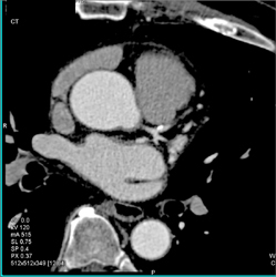 Plaque in LAD - CTisus CT Scan