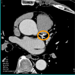 Plaque in LAD - CTisus CT Scan