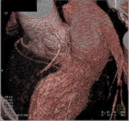 Plaque in LAD - CTisus CT Scan