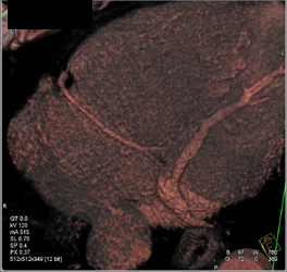 Cardiac Vein and Right Coronary Artery - CTisus CT Scan