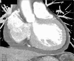 Pericardial Effusion - CTisus CT Scan