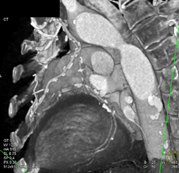 Patent Bypass Grafts - CTisus CT Scan