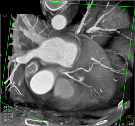 Normal Coronary Arteries - CTisus CT Scan