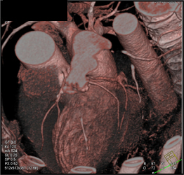 Normal Coronary Arteries - CTisus CT Scan